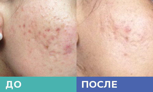 Шрамы от угревой сыпи