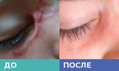 Шрам от укуса собаки