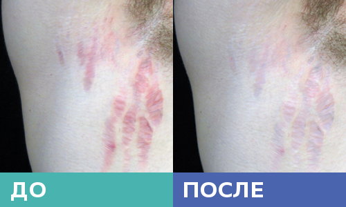 Растяжки под мышкой